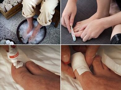 Steaming the legs and applying urea cream on the nails affected by the fungus