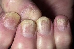 change in the nail due to a fungal infection