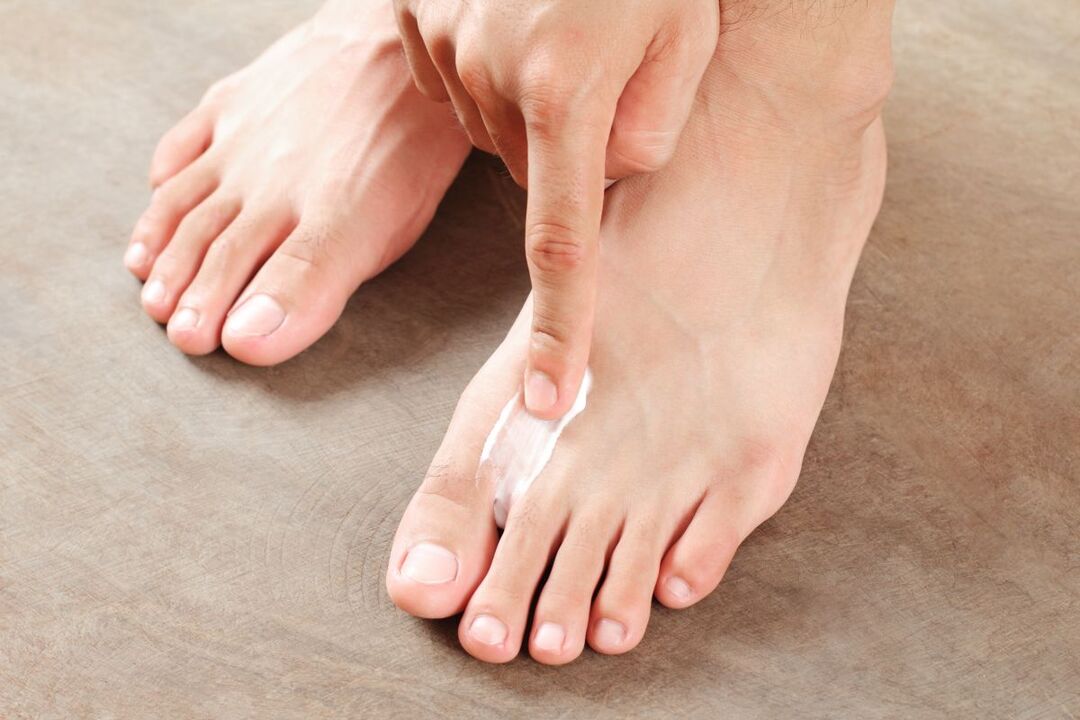 treatment of foot fungus with ointment