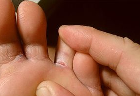 Fungus on the feet of adults