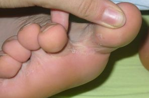 Fungus between your toes