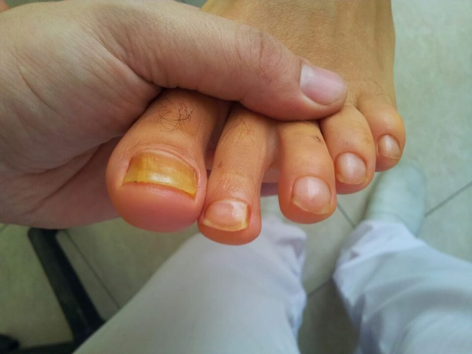 yellowing of the toenails with mushrooms