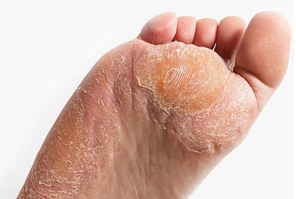 exfoliation of fungal infected skin