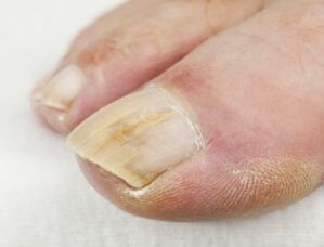 When pushing near your nails, you should not use antifungal drops