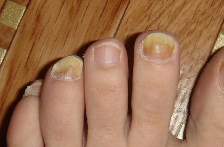 fungal symptoms on the nails and skin of the feet