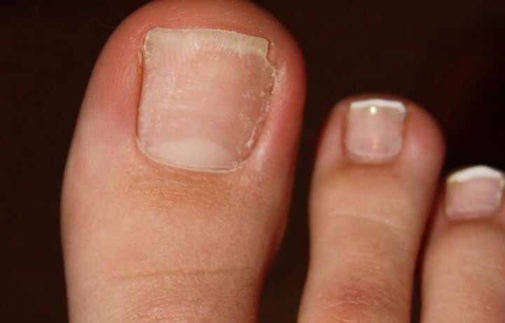 toe fungal symptoms