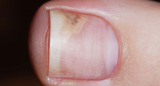 Symptoms of the initial stages of onychomycosis