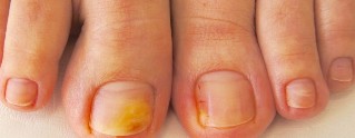 nail fungus, symptoms