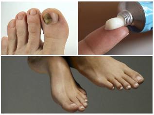 the fungus from the nail, treatment