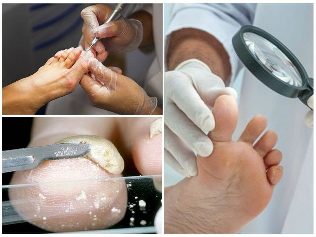 the fungus of the foot, the skin, the diagnosis of