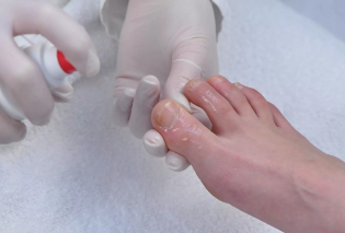 Running the the treatment of nail fungus