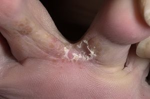 the shape of the foot fungus